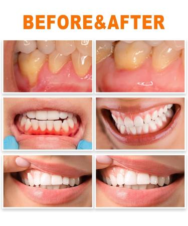 Gum Repair Treatment Ampoules Gum Repair Treatment Ampoules Oral And Gingival Care Essence For Removing Tartar Teeth Repair Protect Gums (2pcs) - Buy Online on GoSupps.com