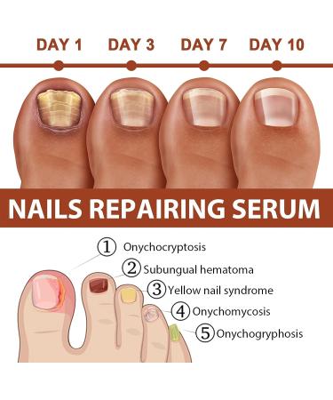 7 Days Nail Growth Serum Set - Repair & Strengthening Cuticle Oil for Damaged Nails - Buy Online on GoSupps.com
