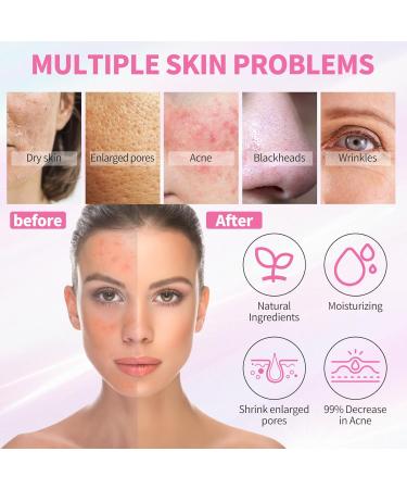 Daily Acne Essentials Kit - 5 Step Facial Skincare Set with Cleanser Face Scrub Clay Mask Toner & Acne Serum Complete Acne Skin Care Kit Wash Away Impurities To Reveal Glowing Skin 5 PCS 5.0 - Buy Online on GoSupps.com