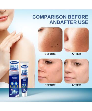 Fast Acting Wart Remover Ointment | Maximum Strength Wart Gel with Salicylic Acid | Effective Treatment for Common Plantar & Genital Warts - International Shipping Available - Buy Online on GoSupps.com