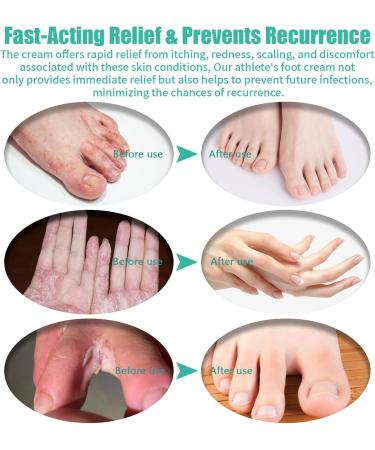 Itchy Feet Relief Cream - Soothing Treatment for Jock Itch Athlete's Foot Psoriasis & More | 4.00 Fl Oz - Adults & Kids - Buy Online on GoSupps.com