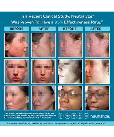 Neutralyze Exfoliating Acne Pads - 2% Salicylic & Mandelic Acid - Maximum Strength Treatment (100 Pads) - Buy Online on GoSupps.com