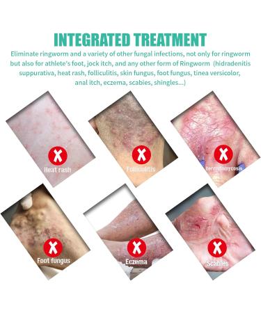 Itchy Feet Relief Cream - Soothing Treatment for Jock Itch Athlete's Foot Psoriasis & More | 4.00 Fl Oz - Adults & Kids - Buy Online on GoSupps.com