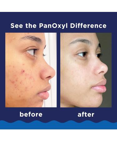 PanOxyl Acne Foaming Wash 10% Benzoyl Peroxide | Maximum Strength Treatment - 5.5 oz - Buy Online on GoSupps.com