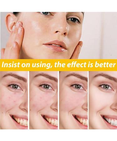 KOAHDE Facial Anti Acne Essence Acne Essence Anti Acne Hydrating Essence Anti Acne Facial Serum Acne Treatment Serum Serum Skin Smoother Acne Removing Moisturizing Serum Skin Rejuvenation Serum - Buy Online on GoSupps.com