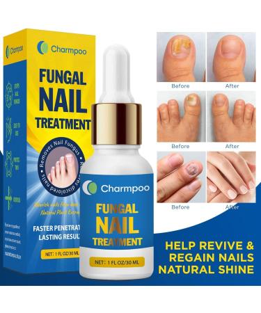 Fungal Nail Treatment - Natural Antifungal Solution for Toe Fungus - 1oz/30ml - Buy Online on GoSupps.com