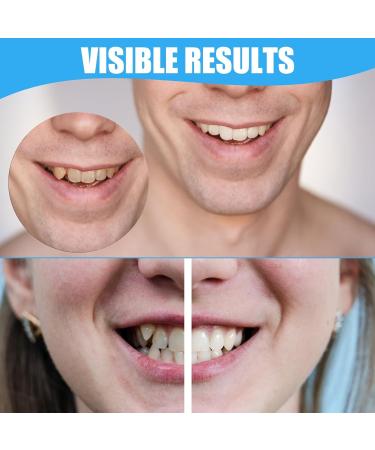 Frenzify Provisional Dentures - 2 Pairs of Cosmetic Veneers for Bad Teeth | Fake Teeth for Instant Smile Makeover - Buy Online on GoSupps.com