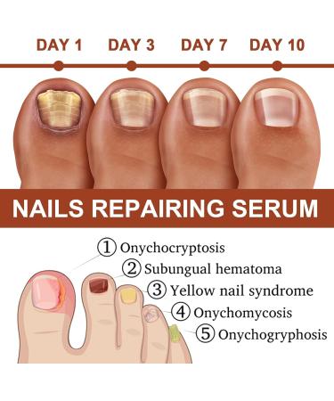7 Day Nail Growth and Strengthening Serum Nail Growth and Strengthening Serum Nail Growth and Strengthening Serum Repair Dam - Buy Online on GoSupps.com