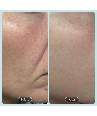 Beautiste 30 DAY MIRACLE BHA 20% Peeling Solution - Clinical Strength BHA Liquid Exfoliant for Clogged Pores Wrinkles & Blackhead Remover - Salicylic Acid Serum & Chemical Exfoliant for Face Peel 1oz - Buy Online on GoSupps.com