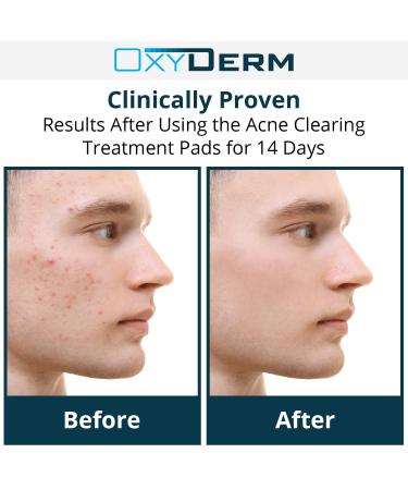 Acne Clearing Treatment Pads - Salicylic, Glycolic & Lactic Acid Formula for Cystic Breakouts and Oily Skin - Buy Online on GoSupps.com