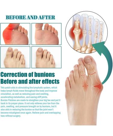 Bunion Cushions - Self-Adhesive Bunion Pads for Bunion Relief and Foot Protection | 1PC - Buy Online on GoSupps.com