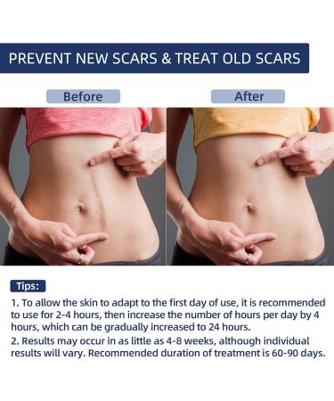 Silicone Scar Tape for Surgical Scars - Extra Long Scar Sheets for C-Section (59 in x 1.5 in) - Buy Online on GoSupps.com