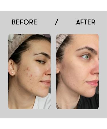 Buy Sane Purifying Face Mask - Zinc Oxide & Vitamins for Radiant Skin | Spa Cleansing & Pore Tightening | 2.54 fl oz - International Shipping - Buy Online on GoSupps.com