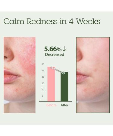 Blithe Korean Skin Care Products 6 Leaves Clear Essence for Rosacea & Redness Relief BHA Toner Cooling Moisturizer for Face Blackhead Treatment Evening Primrose Wintergreen Green Tea 1.83 Oz 6 Calming Leaves 1.83 Fl Oz (  - Buy Online on GoSupps.com