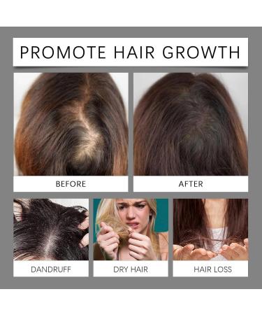 Huile Pousse Cheveux Anti-Chute Pour Femme Et Homme S rum Naturel Avec Huile De Ricin et Gingembre Booster Croissance Cheveux Non Irritante Traitement Rapide Pour Repousse 30ml - Buy Online on GoSupps.com