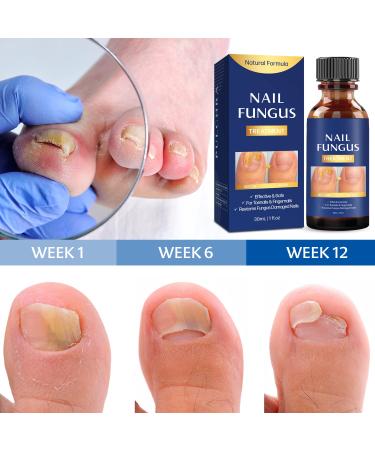 Extra Strength Toe Nail Fungus Treatment - Effective Nail Repair Solution for Healthy Nails - Buy Online on GoSupps.com