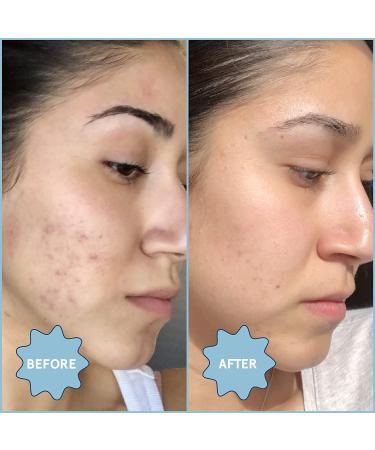 Blume Meltdown - Blue Tansy Face Oil - Acne Treatment + Pore Minimizer - Skin-Smoothing Face Serum with Black Cumin Seed & Rosehip Oil - Helps Calm Redness and Improve Texture (1 Fl oz) 1 Fl Oz (Pack of 1) - Buy Online on GoSupps.com