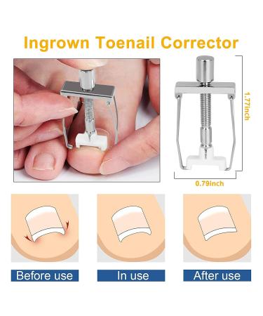 Professional Ingrown Toenail Removal Kit - 92 PCS Treatment Tool for Toe Nail Correction, Pain Relief, and Protection - Buy Online on GoSupps.com