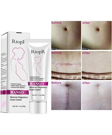 40G Remove Pregnancy Scars Scars and Acne Treatments for Pregnancy - Buy Online on GoSupps.com
