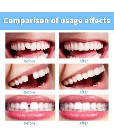 DMNQ Temporary Tooth Repair Kit | Artificial Teeth & Dental Care Set for Missing & Broken Teeth | Complete Oral Tools Included - Buy Online on GoSupps.com