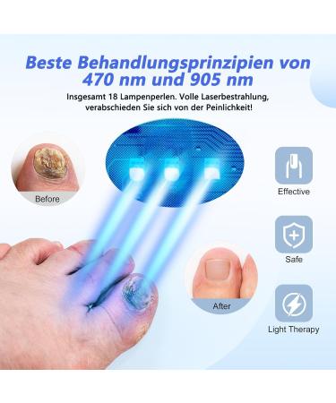 Xyhaoai Light Therapy Device for Nail Fungus Treatment | Highly Efficient Cold Laser Therapy for Healthy Nails - Buy Online on GoSupps.com