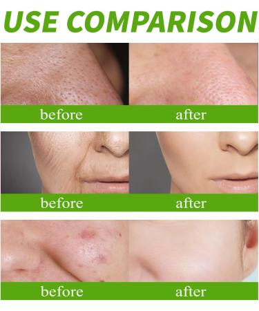 Centella Calming Gel Cream Face Moisturiser For Neck Face And Eye Acne Cream With Nicotinamide And Licorice Root extract Moisturiser Face Women Facial Care Face Cream For All Skin Types.(60ml) - Buy Online on GoSupps.com