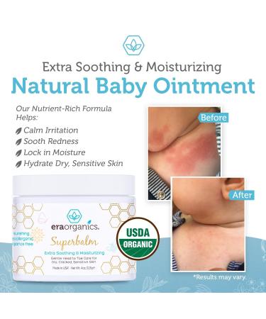 Extra Strength Baby Eczema Cream & Cradle Cap Treatment - Gentle Soothing Healing Ointment with Organic Food-Grade Superfoods for Dry Itchy Irritated Skin - 4oz - Buy Online on GoSupps.com