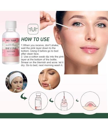 Acne Drying Lotion | Overnight Acne Treatment for Pimples & Blemishes | Fast Spot Treatment (1OZ) - International Shipping - Buy Online on GoSupps.com