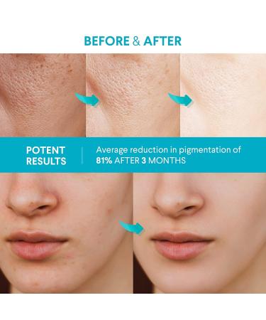 Healpool Rapid Dark Spot Remover for Face and Body - Dark Spot Corrector Serum - 1.7oz - Buy Online on GoSupps.com