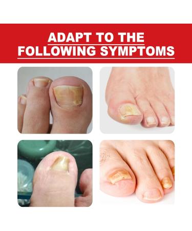 Ingrown Toenail & Fungal Nail Treatment Drops 10ML - Nail Care to Strengthen & Renew Damaged Nails - Buy Online on GoSupps.com