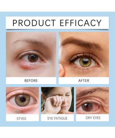 Stye Eye Treatment & Chalazion Remover | Eye Relief Serum & Gentle Lash Cleanser - Fast International Shipping - Buy Online on GoSupps.com