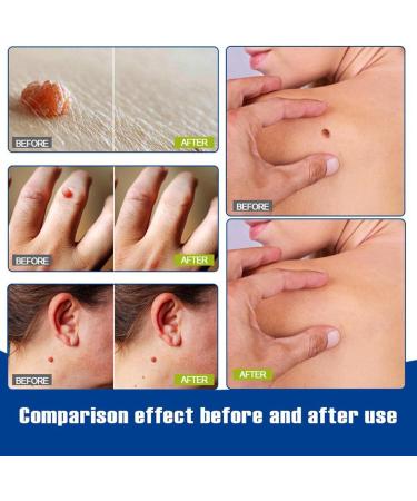 Skin Spot Removal Pen | Pack of 2 x 4ml Pens for Body Care | Gentle Non-Greasy Portable Liquid for Body and Face - Buy Online on GoSupps.com