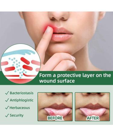 Ulcer Breath Sprays Mouth Ulcers Treatment Spray Ulcer Treatment Canker Sore Treatment Canker Relief Spray Herbal Mouth Spray Ulcer Pain Relief Spray Breath Spray for Bad Breath Mouth Freshener Spray - Buy Online on GoSupps.com