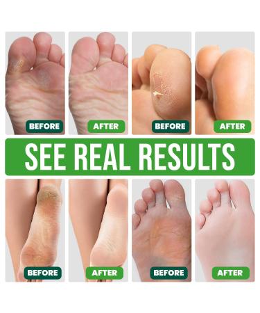 VeraCare Lavender Foot Peel Mask - 2 Pairs - Exfoliating & Moisturizing Treatment for Cracked Heels, Dead Skin & Calluses - Baby Soft Feet Results - Buy Online on GoSupps.com