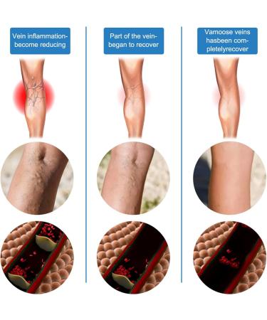 Venoheal Varicose Vein Treatment Cream Relie Vein Treatment Cream Anti-Varicose Vein Treatment for Legs Varicose Vein Care Cream Vein Care Cream for Legs Pen & Cream - Buy Online on GoSupps.com