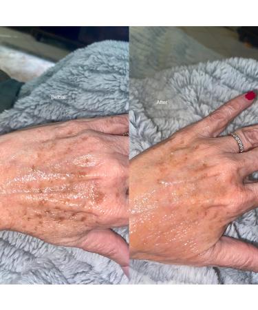 Dark Spot Corrector & Brightening Serum with Kojic Acid, Vitamin C, Salicylic Acid & More | Melasma Treatment Cream by Admire My Skin - Buy Online on GoSupps.com