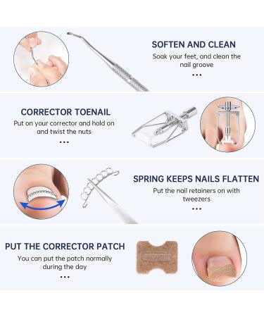 Ingrown Toenail Treatment Kit with 12 Podiatry Braces | Corrector Tool & 50pcs Patch | 10 Strips | White - Buy Online on GoSupps.com