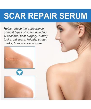 Silicone Scar Gel - Scar Removal Cream - 30g Scar Cream - Scar Removal and Soothing Cream for Surgical Scars Acne Scars C-Section Burns Stretch Marks - Effective for Old and New Scar - Buy Online on GoSupps.com