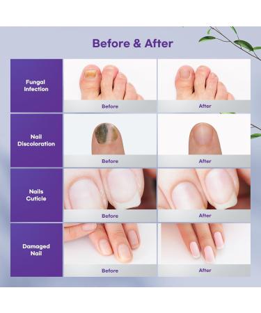Toenail Fungus Treatment Spray - Extra Strength 3-in-1 Nail Fungus Cure for Stronger Healthier Toenails (100mL) - Fast International Shipping - Buy Online on GoSupps.com