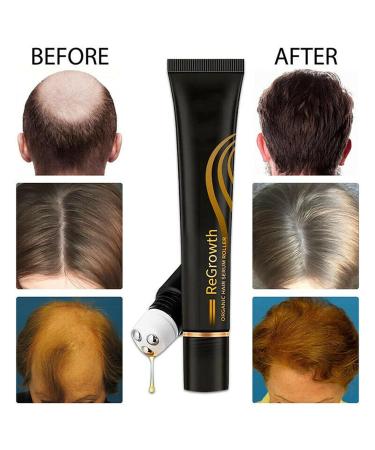 20ml Organic Hair Regrowth Serum Roller Set | Herbal Scalp Intense Roll-On for Men & Women | Triple Massager Hair Growth Essence (3PCs) - Buy Online on GoSupps.com