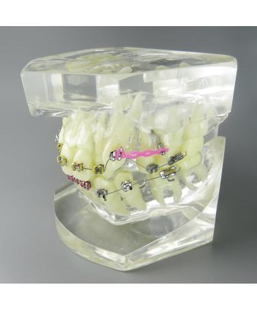 Shop Dental Malocclusion Orthodontic Treatment Model - Metal Brackets & Colorful Ties | M3005 - International Shipping Available - Buy Online on GoSupps.com