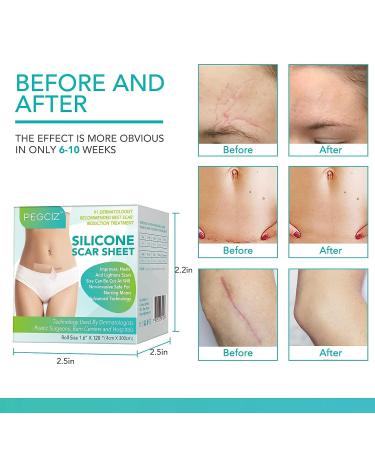 Silicone Scar Sheets - Professional Scar Removal Tape for C-Section, Surgery, Burn, Keloid, Acne - Soften and Flatten Scars - 1.6 x 120 - 3M Roll - Buy Online on GoSupps.com