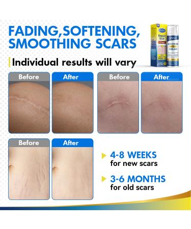 BORMSI Scar Cream Silicone Advanced Scar Treatment Gel - Repair Surgical Scars, Keloids, Stretch Marks, Acne - 1.76oz(50G) White - Buy Online on GoSupps.com