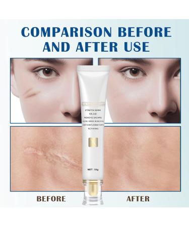 Scar Gel for Kids & Adults - Scar Cream Reduces Visibility of Scars & Decreases Tissue Tension & Itching - for All Types of Scars - Fast Absorption - Buy Online on GoSupps.com