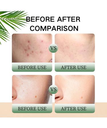 Spot Treatment - Acne Treatment - Face Serum for Women - Tea Tree Oil Serum Face - Dark Spot Correcting Glow Serum Remover for Face - Hydrating Face Serum - Fade Acne Mark 60ml - Buy Online on GoSupps.com
