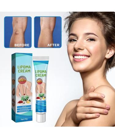 Garner Skin Lump-Free Lipoma Removal Ointment - Natural Vegetable Formula for Clump Removal, Anti-Swelling, Body Care - 1pc - Buy Online on GoSupps.com