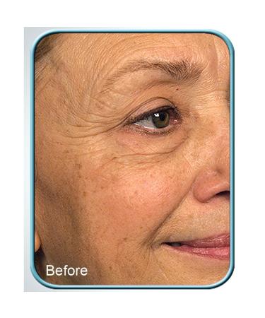 Stem Cell Therapy Anti-Aging Cream Set - Reduce Wrinkles & Signs of Aging (4 Jars) | Biologic Solutions - Buy Online on GoSupps.com