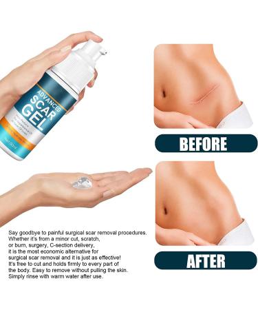 Kelo-cote Scar Gel 15g-2 Pack | Advanced Formula for Surgical, Stretch Marks, C-section, Cosmetic Surgery, Burn & Children's Scars | Softens, Flattens, Eliminates Redness - Buy Online on GoSupps.com
