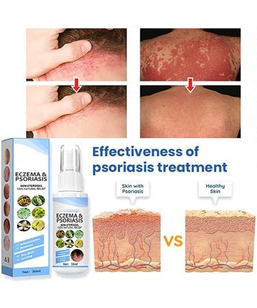 Dubush 30ml Herbal Psoriasis Relief Spray - Natural Eczema & Psoriasis Treatment - Soothing Moisturizing Mist - Set of 3 - Buy Online on GoSupps.com