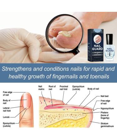 Onyxoguard Nail Growth and Repair Serum Onyxoguard Nail Repair Serum Nail Strengthener for Damaged Nails Nail Strengthening and Growth Conditioner Nail Repair Treatment Nail Strengthener Polish - Buy Online on GoSupps.com